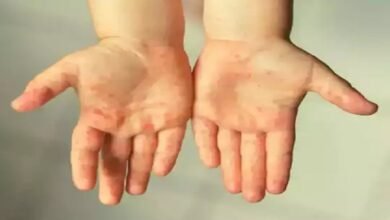 Photo of 82 बच्चे टोमैटो फ्लू से संक्रमित, चेतावनी जारी