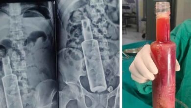 Photo of ढाई घंटे की सर्जरी के बाद पेट से शराब की पूरी बोतल बाहर निकल गई